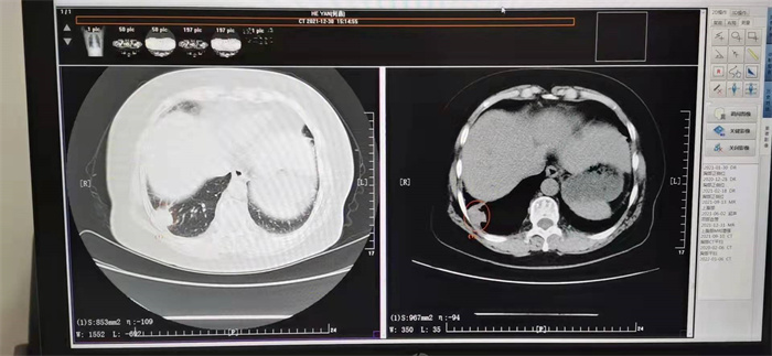 胆管癌术后复发，肺转移，术前CT.jpg